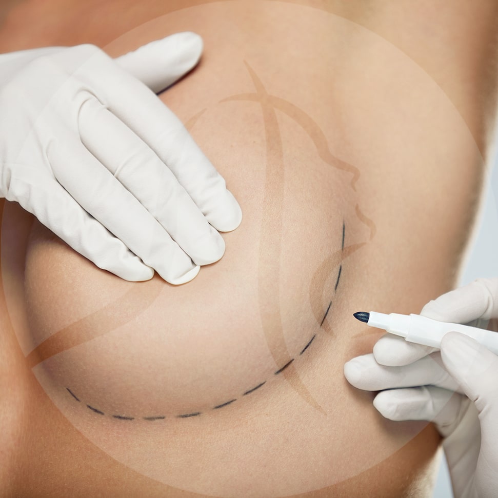 breast implant revision in cleveland