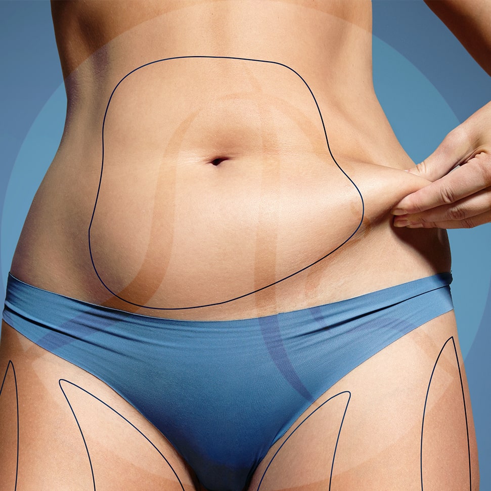 coolsculpting in cleveland