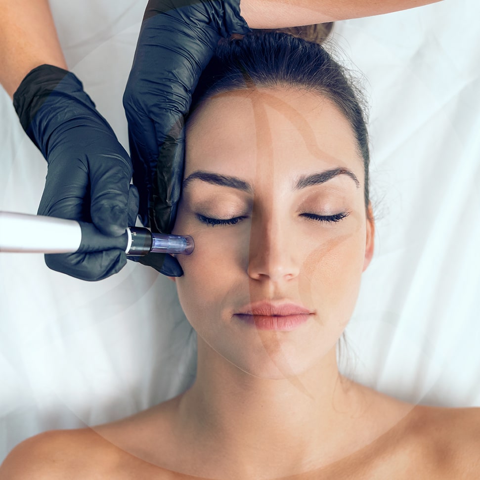 microneedling in cleveland